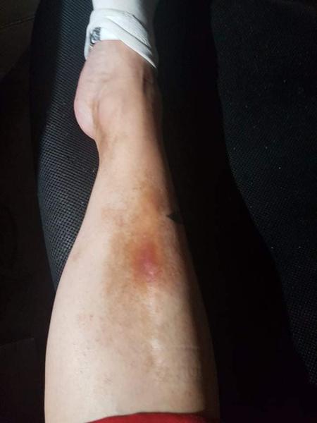 Praskanie drobných ciev - máte s tým skúsenosti?