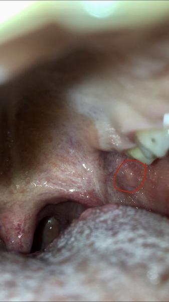 Môže to byť afta alebo hnis?