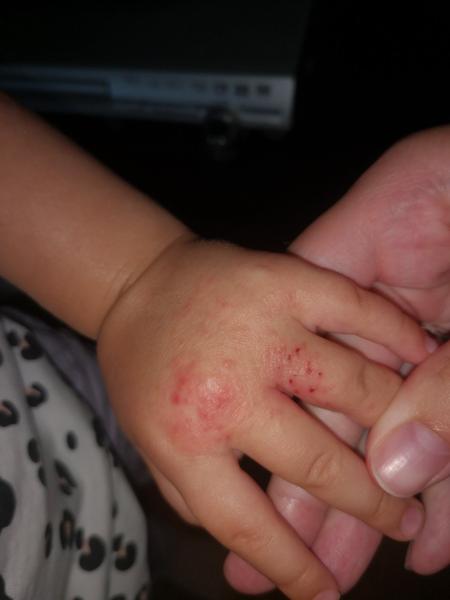 Atopický ekzém u detičiek