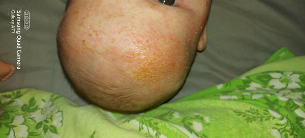 Má môj trojmesačný synček ekzém?