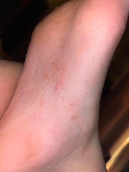 Čo môžu znamenať vyrážky na nohe u detí?