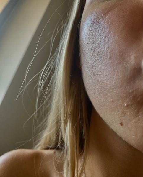 Malé vyrážky na pleti - čo robiť?