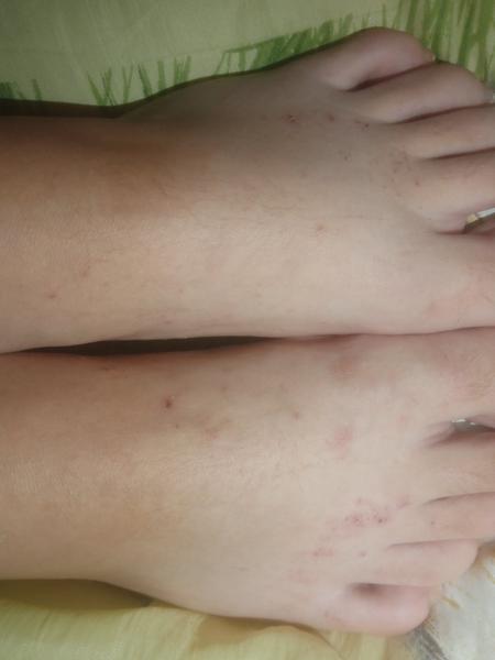 Prečo ma celé telo svrbí a mám vyrážky?