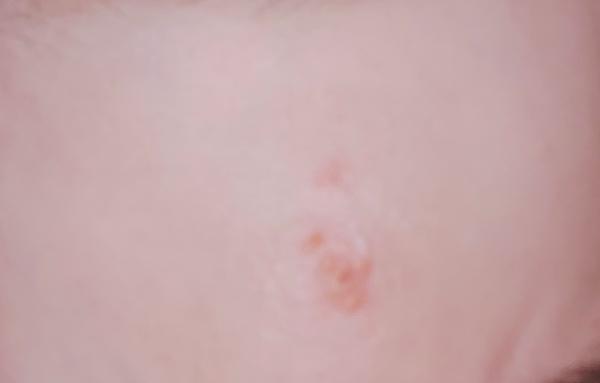 Akú vyrážku to mám na čele?