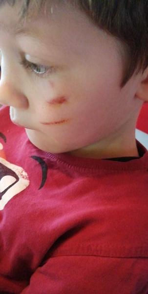 Je možné odstrániť dieťaťu jazvu po úraze?