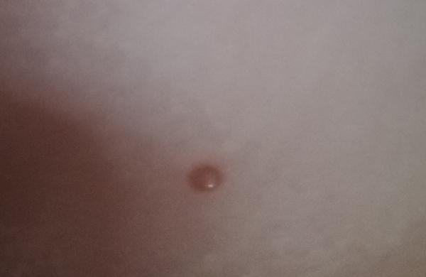 Tvrdý vriedok na stehne