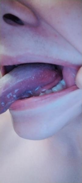 Ako zmierniť bolesť jazyka?