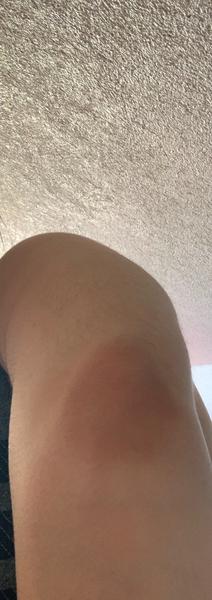 Čo to mám na lakti?