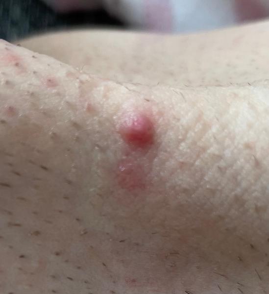 Je toto genitálna bradavica?