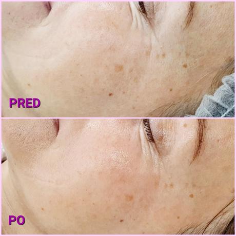 Radiothermolifting - omladenie rádiofrekvenciou, 