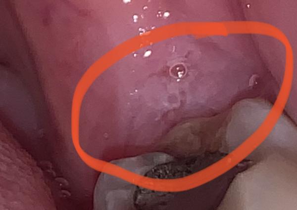 Bolestivé podnebie a ďasná: Možné príčiny?