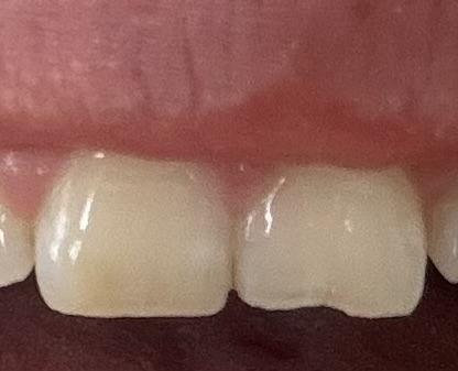 Ako opraviť zlomený predný zub a aké sú náklady?