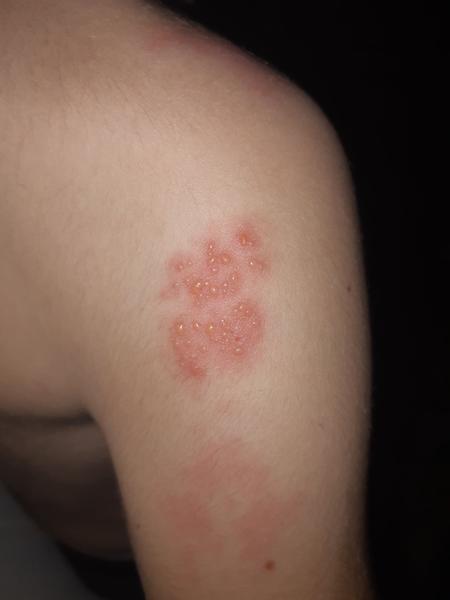 Aký problém znamená zhluk vyrážok u 7-ročného syna?