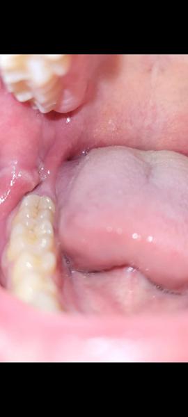 Čo spôsobuje opuch na líci vľavo?