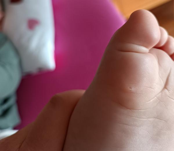 Je to kurie oko alebo bradavica?