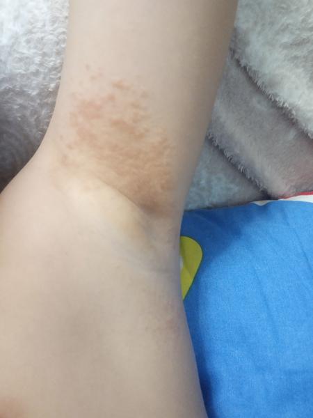 Aké vyrážky v oblasti pazúch má môj 7 ročný syn?