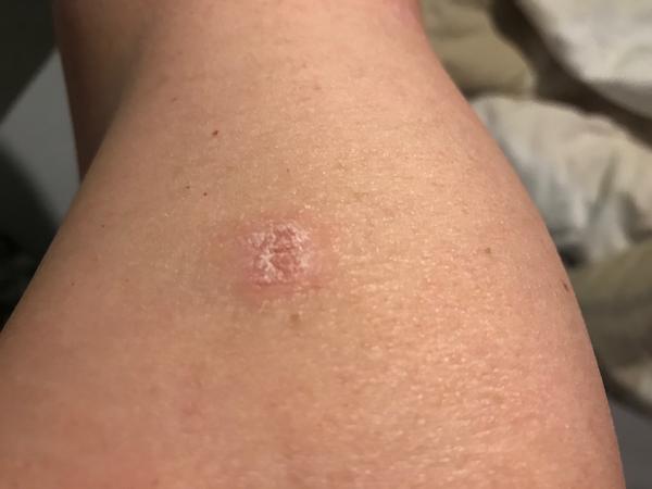 Aký kožný problém ma trápi už dva mesiace?