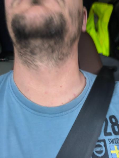 Príčiny hnisavých vyrážok na hrudi: Ako tomu predísť?