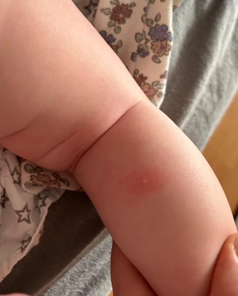 Je to štípanec od ploštíc?