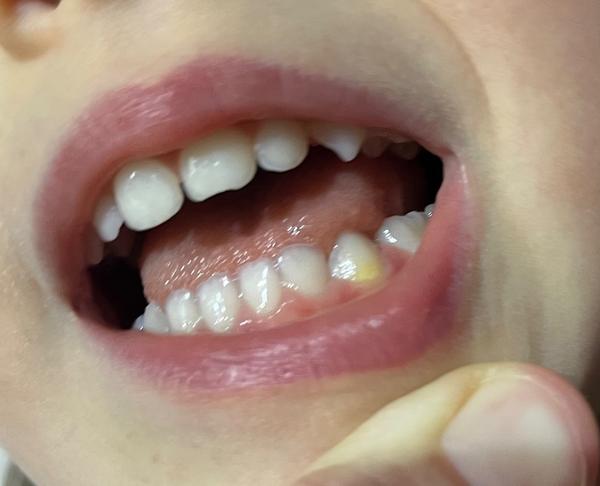 Je toto zubný kaz u dvojročného dieťaťa?