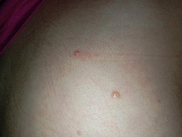 Čo môže spôsobovať pľuzgieriky na chrbáte a rukách?