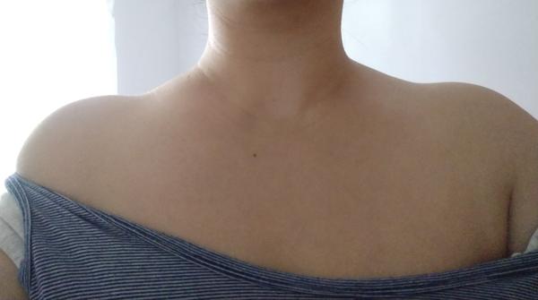 Ako sa dajú riešiť vpadnuté ramená?