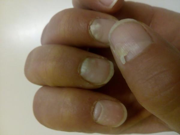 Čo to môže byť na nechtoch?