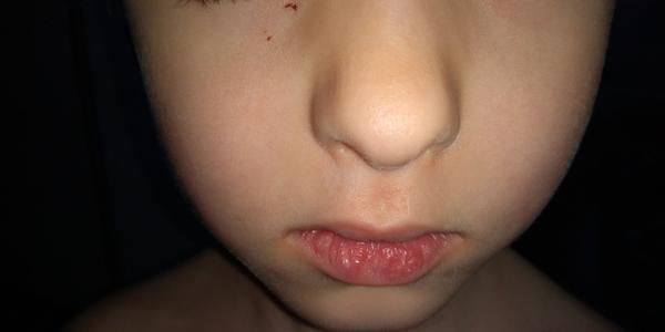 Vyrážky 4-ročného týždeň po chorobe, čo to môže byť?