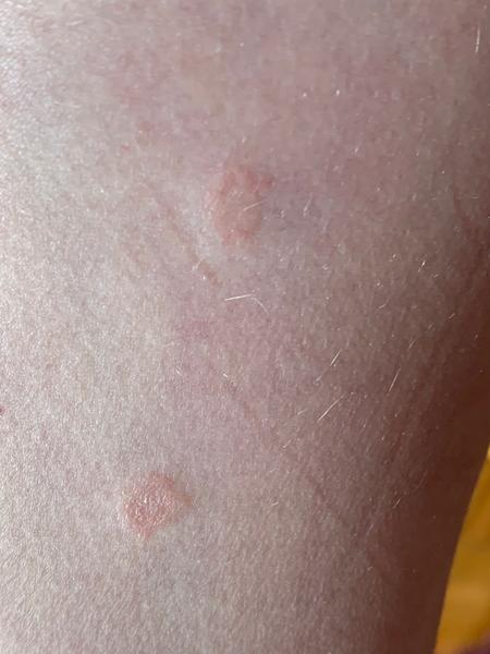 Aké fľaky sa robia mojej dcérke na koži?