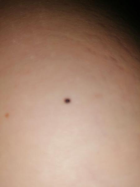 Môže byť vystúpené znamienko melanóm?