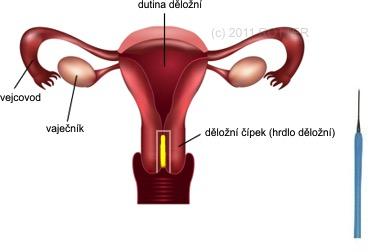 Konizácia krčka maternice