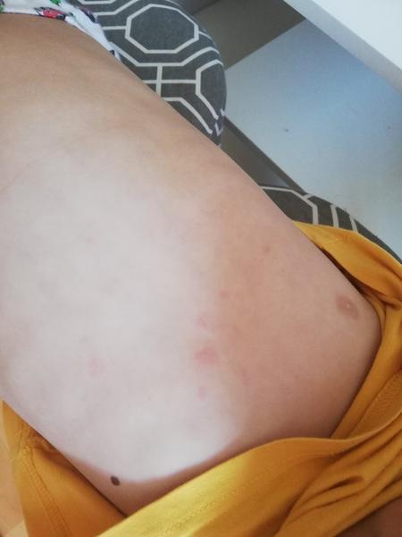 Aké vyrážky má môj syn po očkovaní v 5. rokoch?