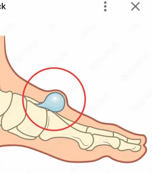Mate skúsenosť s bolesťou na chodidle?