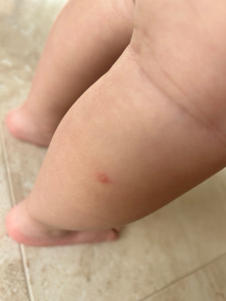 Čo spôsobuje opakujúce sa vodnaté vyrážky?