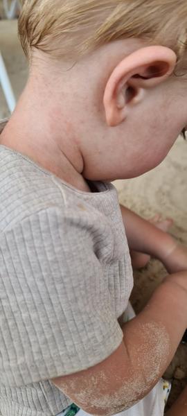 Môže to byť alergia na slnko?