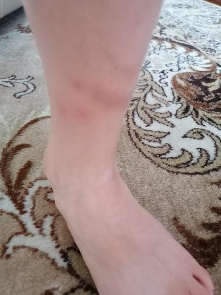 Má môj syn alergickú reakciu, alebo sú to štípance?