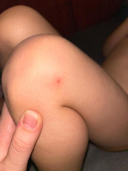 Sú to začínajúce kiahne u dieťaťa?