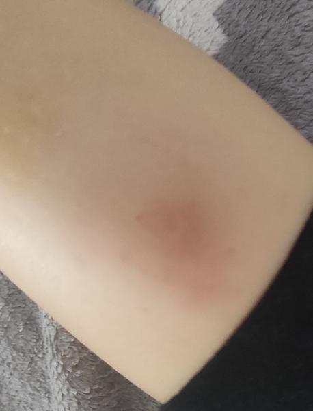 Štípance od komárov: Ako predísť komplikáciám?