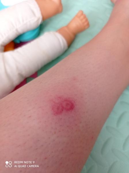 Alergická reakcia - komár