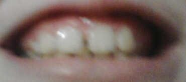 Medzera medzi prednými zubami