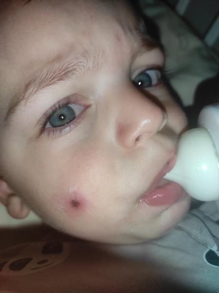 Z čoho má môj 2,5 ročný syn vyrážku na tvári?