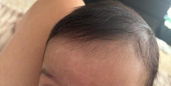 Škvrny na pokožke bábätka