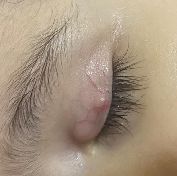 Gulička na viečku u 2,5-ročného