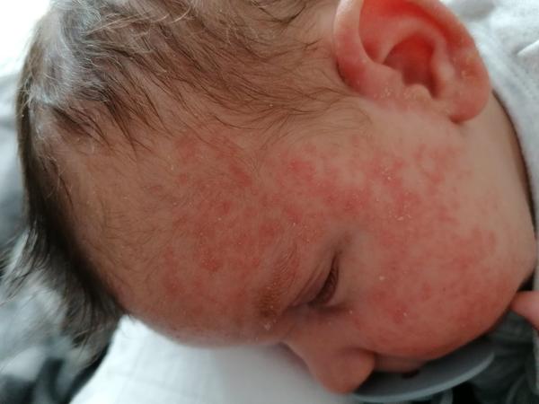Aké vyrážky má môj 5 týždňový syn na tvári?