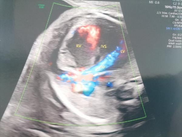 Čo hrozí môjmu bábätku?