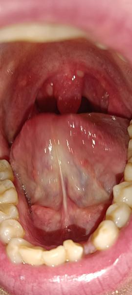 Ako riešiť problémy s hrdlom a prehĺtaním?