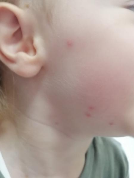 Aké vyrážky má môj syn?