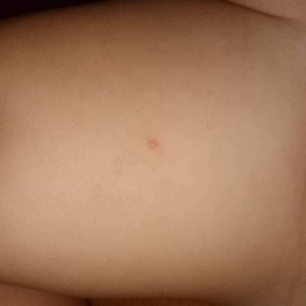 Má moje dieťa kiahne?