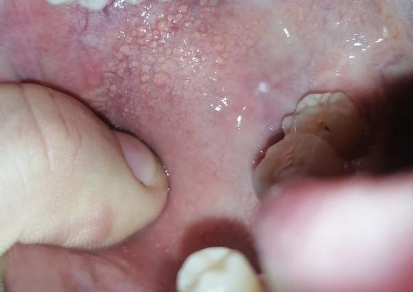 Je biela hrčka na vnútornom líci dôvodom na obavy?