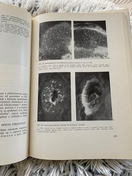 Systémový lupus erythematosus psoriáza,